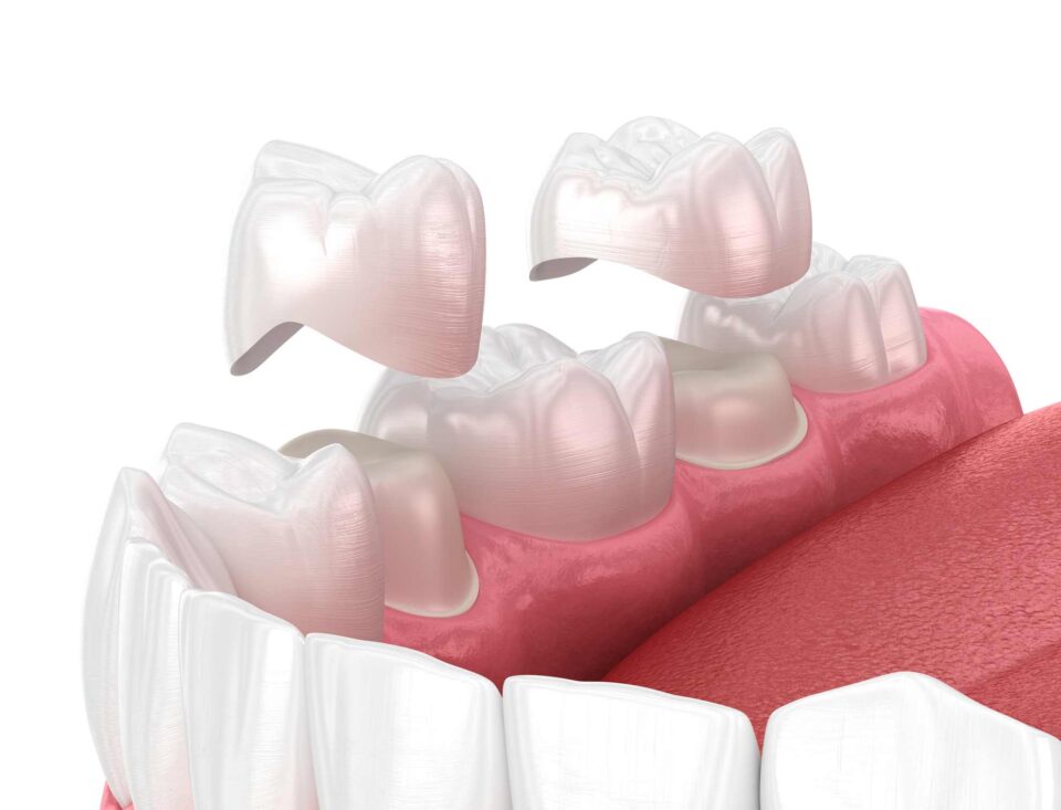 Custom dental crowns are being placed to restore teeth at Dental Care of Wheaton in Wheaton, IL.