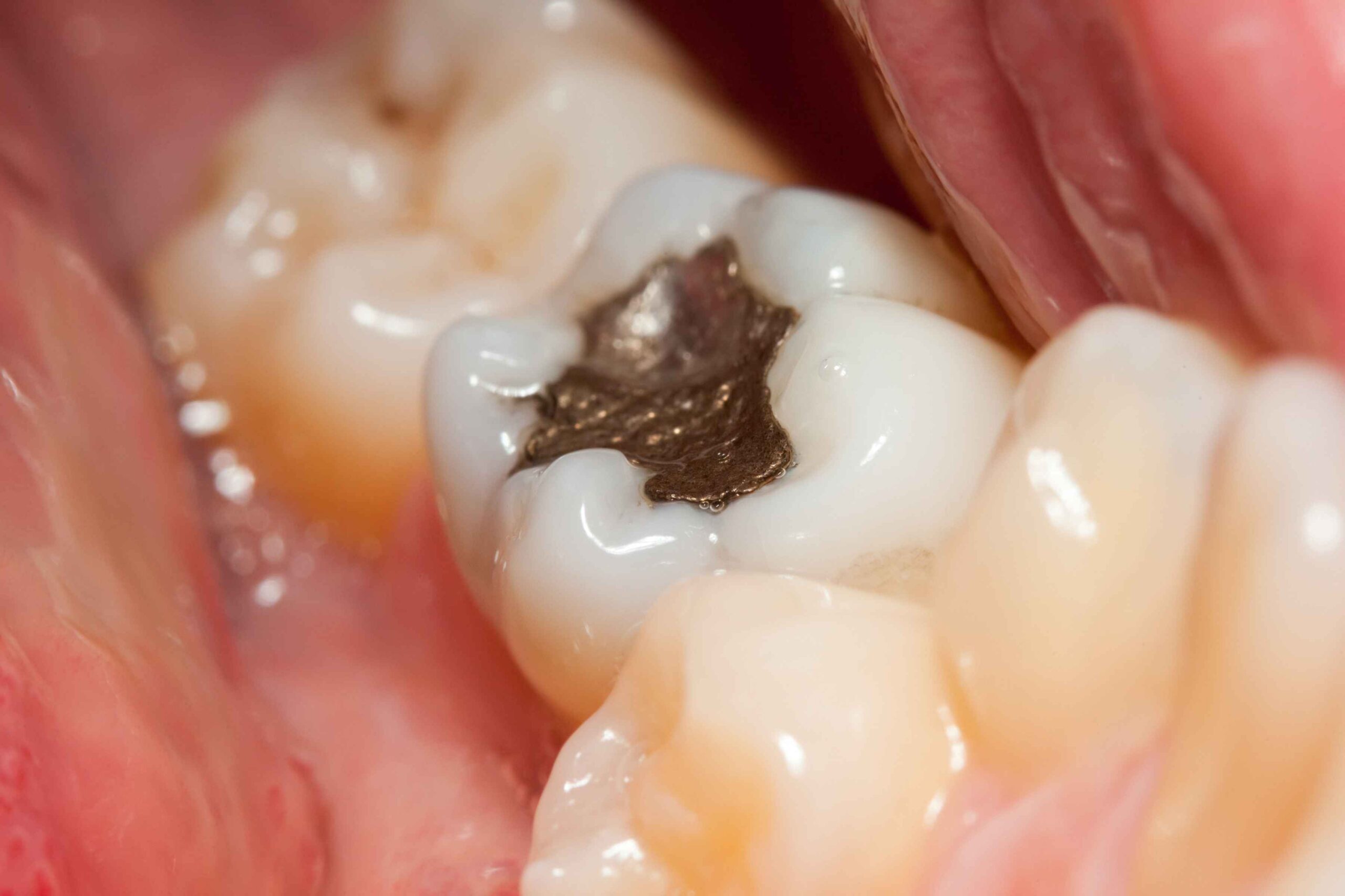 Close-up of a molar with a silver amalgam filling used to treat tooth decay in Wheaton, IL
