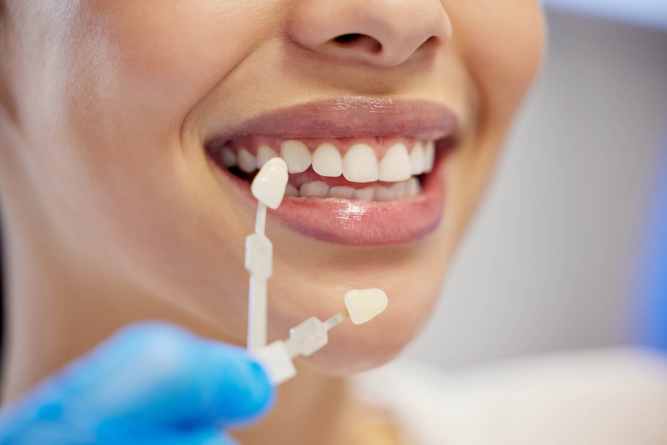 Close-up of dental veneers being matched to natural teeth for a smile makeover in Wheaton, IL