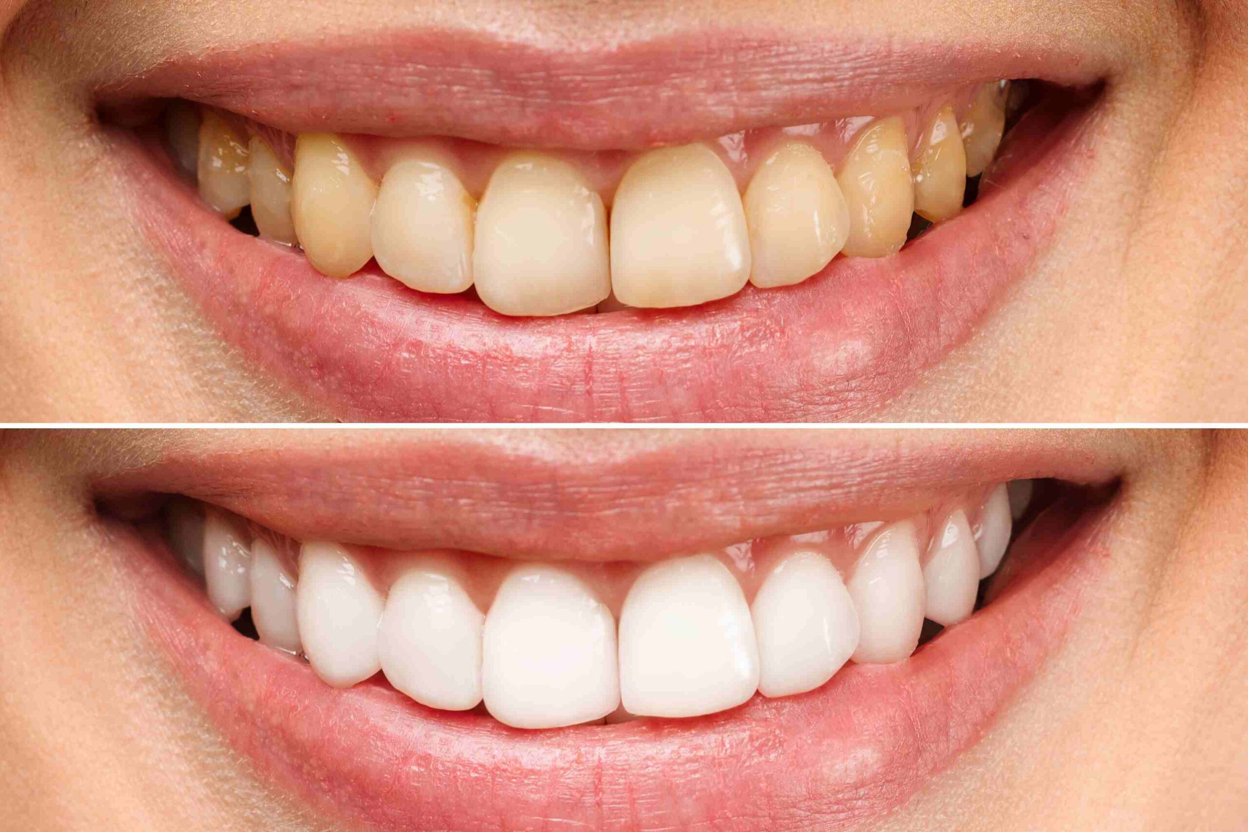 Before and after teeth whitening showing a brighter, whiter smile at Dental Care of Wheaton.