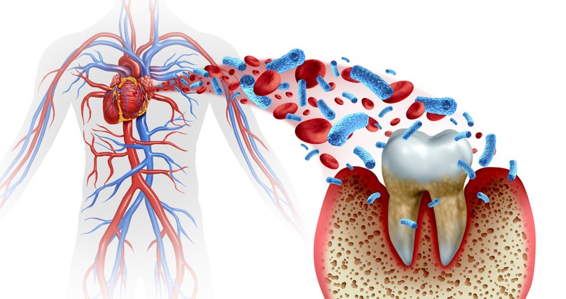 Diagram showing the link between gum disease, bacteria, and heart health in Wheaton, IL